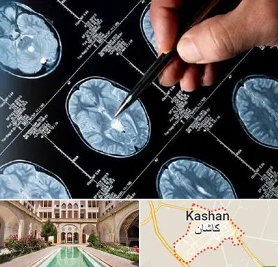 دکتر تشنج در کاشان