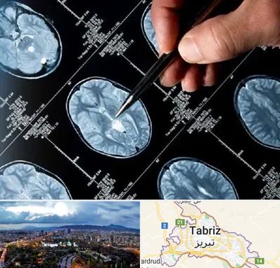 دکتر تشنج در تبریز