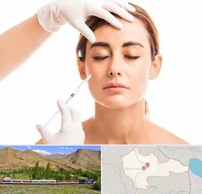 تزریق ژل گونه در خاش