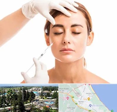 تزریق ژل گونه در رودسر