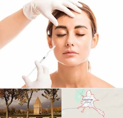 تزریق ژل گونه در تویسرکان