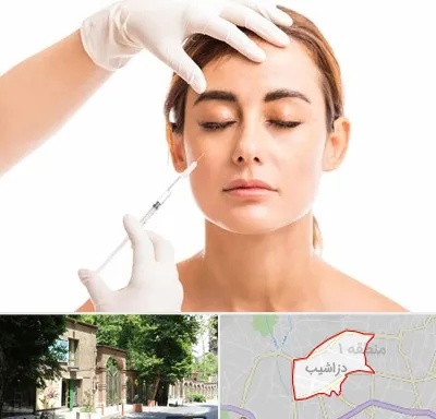 تزریق ژل گونه در دزاشیب