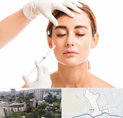 تزریق ژل گونه در اوین