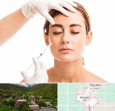 تزریق ژل گونه در کلاله