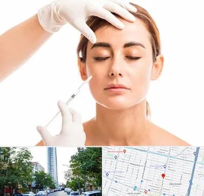 تزریق ژل گونه در امامت مشهد