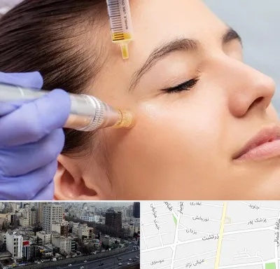 میکرونیدلینگ در زرتشت