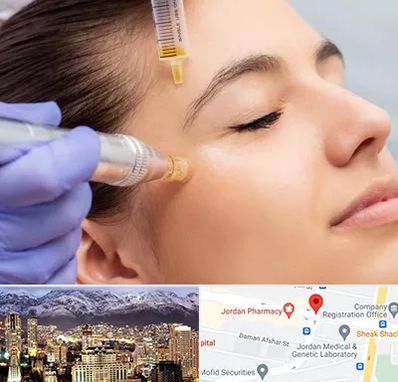 میکرونیدلینگ در جردن