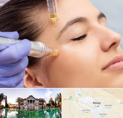 میکرونیدلینگ در شیراز