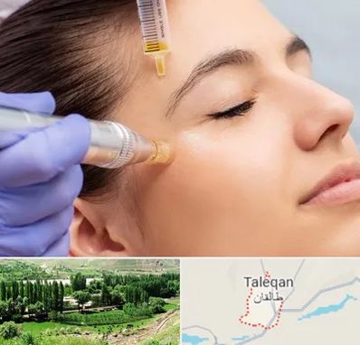 میکرونیدلینگ در طالقان