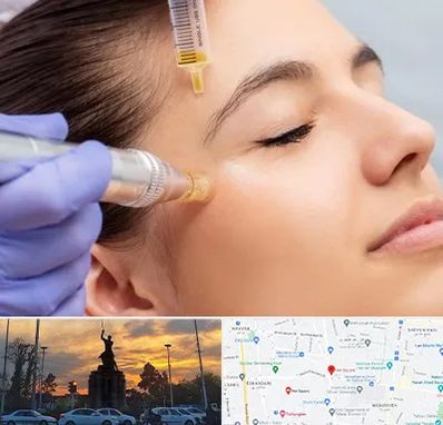 میکرونیدلینگ در میدان حر