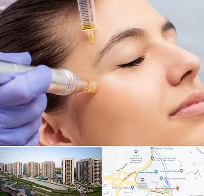 میکرونیدلینگ در المپیک