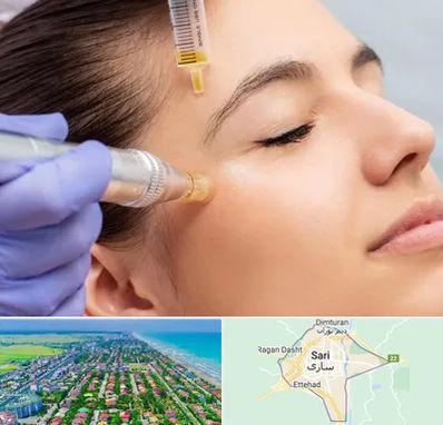 میکرونیدلینگ در ساری