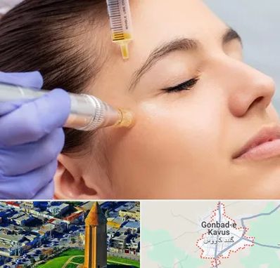 میکرونیدلینگ در گنبد کاووس