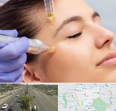 میکرونیدلینگ در منطقه 17 تهران