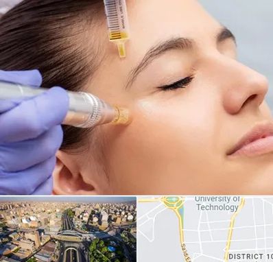 میکرونیدلینگ در استاد معین