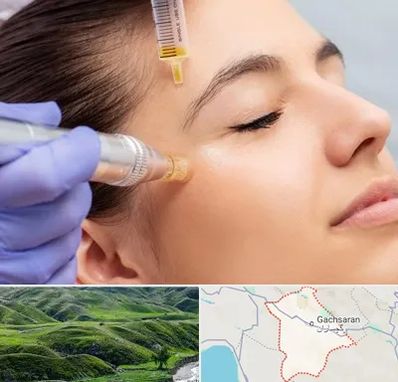 میکرونیدلینگ در گچساران