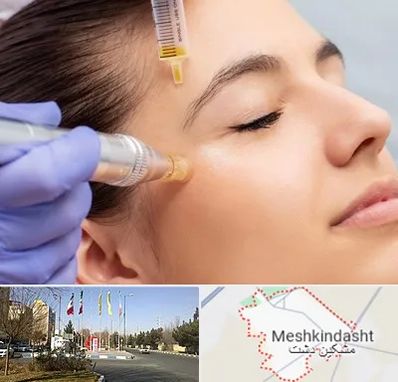 میکرونیدلینگ در مشکین دشت