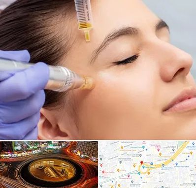 میکرونیدلینگ در میدان ولیعصر