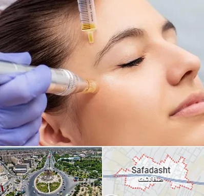 میکرونیدلینگ در صفادشت