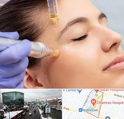 میکرونیدلینگ در اقدسیه