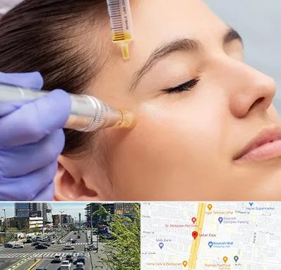 میکرونیدلینگ در ستاری