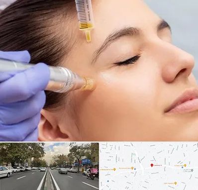 میکرونیدلینگ در دولت