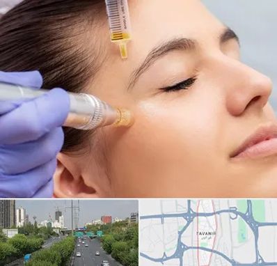 میکرونیدلینگ در توانیر