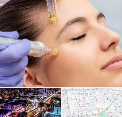 میکرونیدلینگ در منظریه رشت