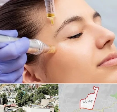 میکرونیدلینگ در جماران