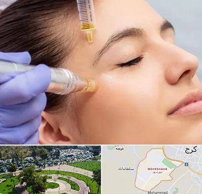 میکرونیدلینگ در مهرشهر کرج