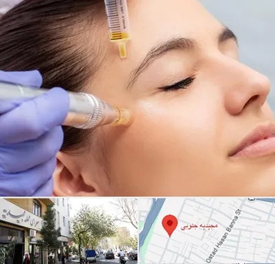 میکرونیدلینگ در مجیدیه جنوبی