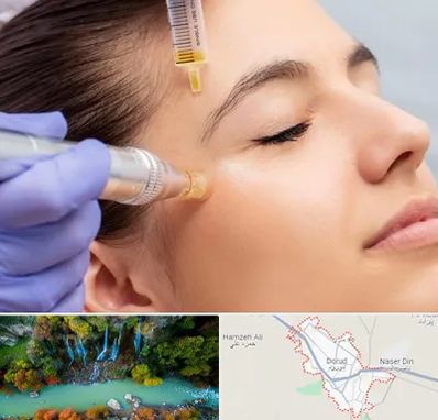 میکرونیدلینگ در دورود