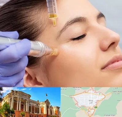 میکرونیدلینگ در خوی