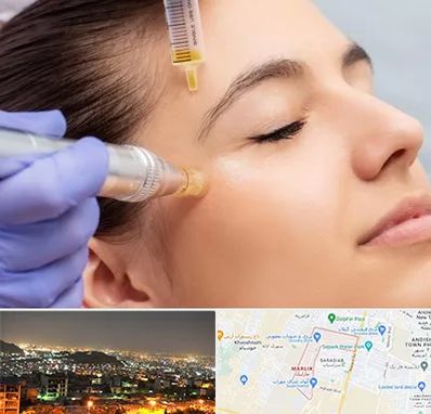میکرونیدلینگ در مارلیک کرج