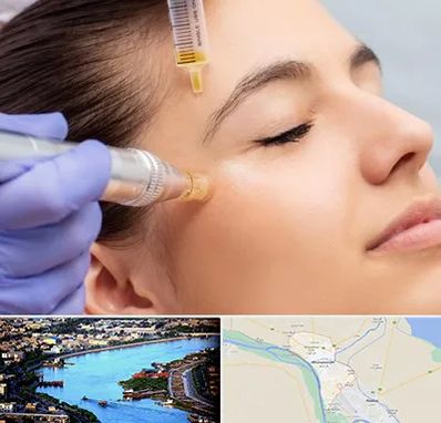 میکرونیدلینگ در خرمشهر