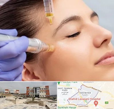 میکرونیدلینگ در حکیمیه