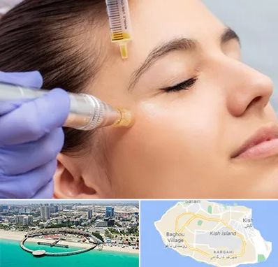 میکرونیدلینگ در کیش