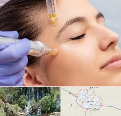 میکرونیدلینگ در شیروان