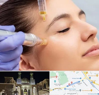 میکرونیدلینگ در زرگری شیراز