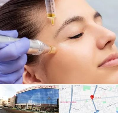 میکرونیدلینگ در نصف راه تبریز