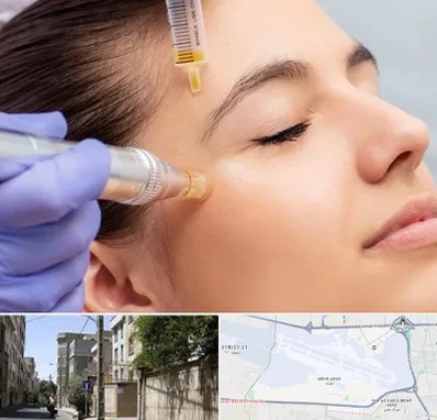 میکرونیدلینگ در مهرآباد