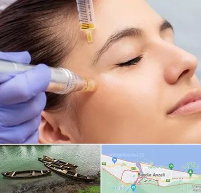میکرونیدلینگ در بندر انزلی