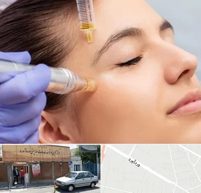 میکرونیدلینگ در وردآورد