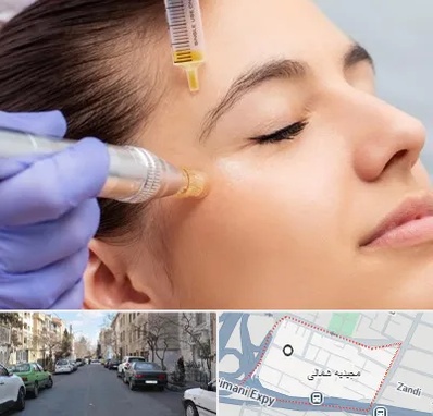 میکرونیدلینگ در مجیدیه شمالی