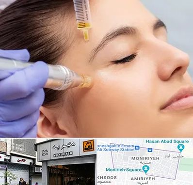 میکرونیدلینگ در منیریه