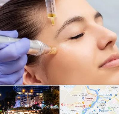 میکرونیدلینگ در کیانپارس اهواز