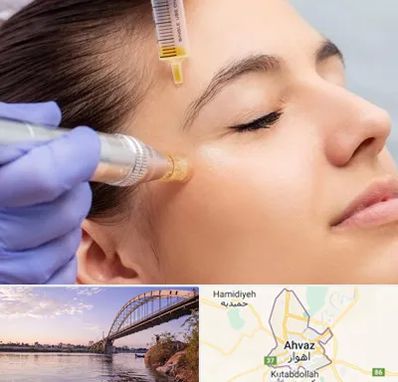 میکرونیدلینگ در اهواز