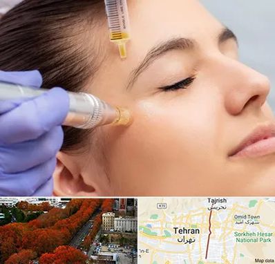 میکرونیدلینگ در ولیعصر