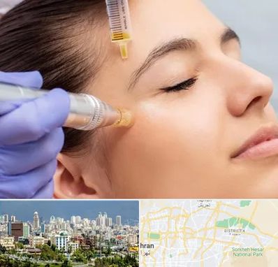 میکرونیدلینگ در شرق تهران تهران