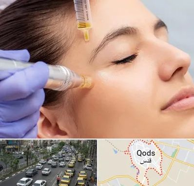 میکرونیدلینگ در شهر قدس